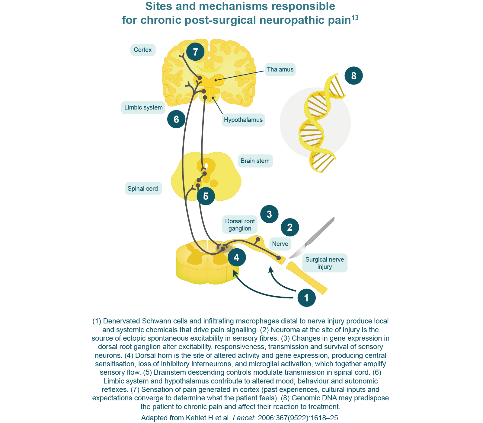 Sites and mechanisms responsible for chronic post surgical neuropathic pain
