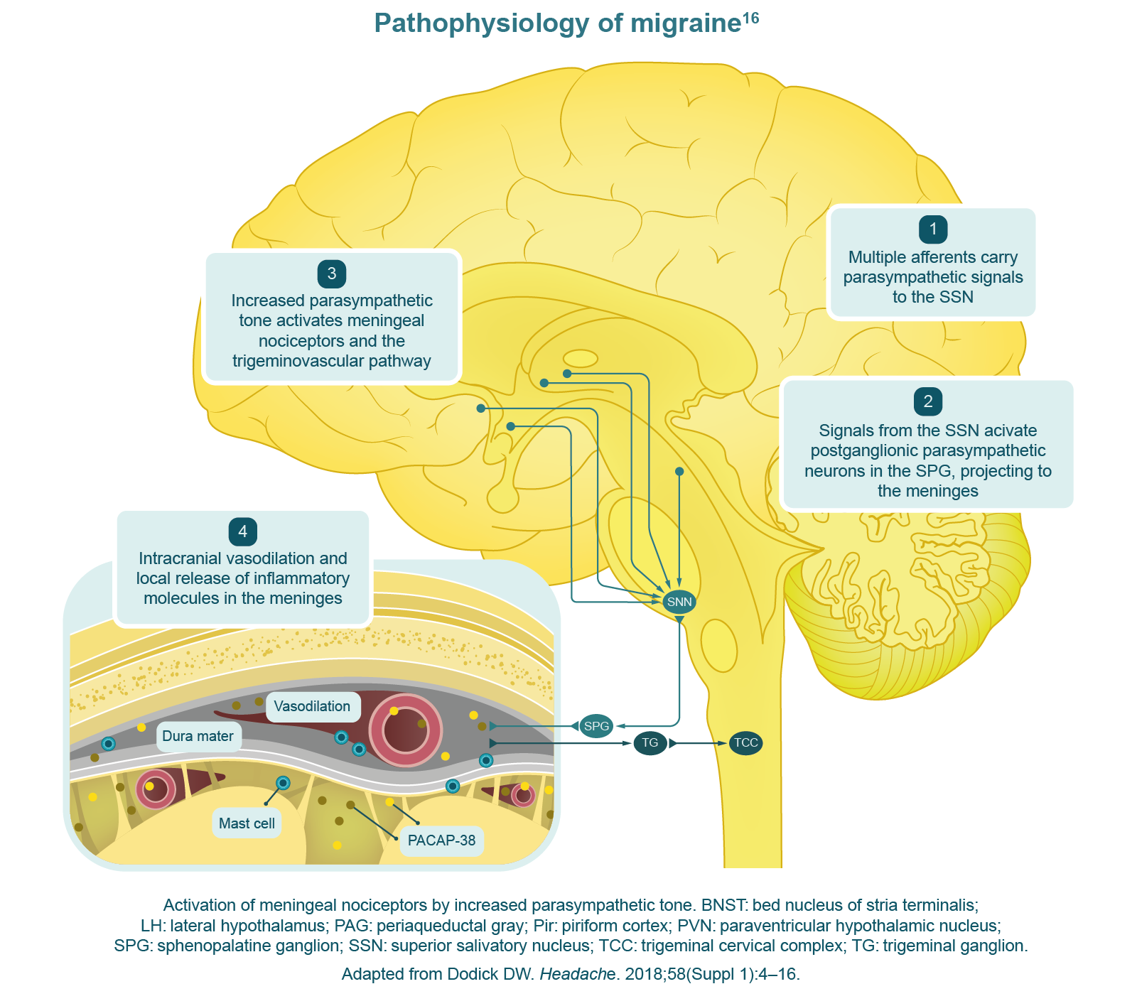 Pathophysiology of migraine