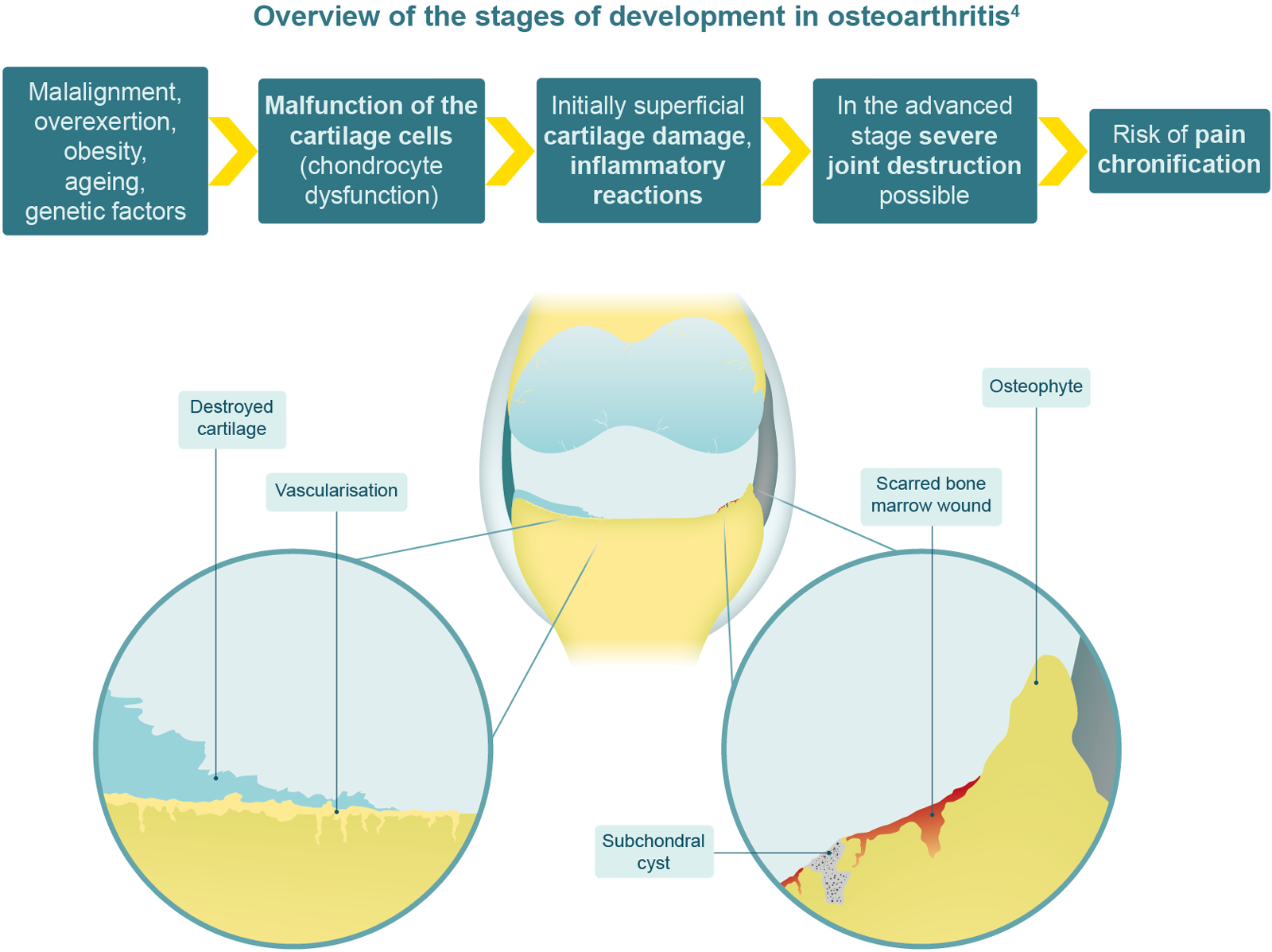 Overview of the stages of development in osteoarthritis
